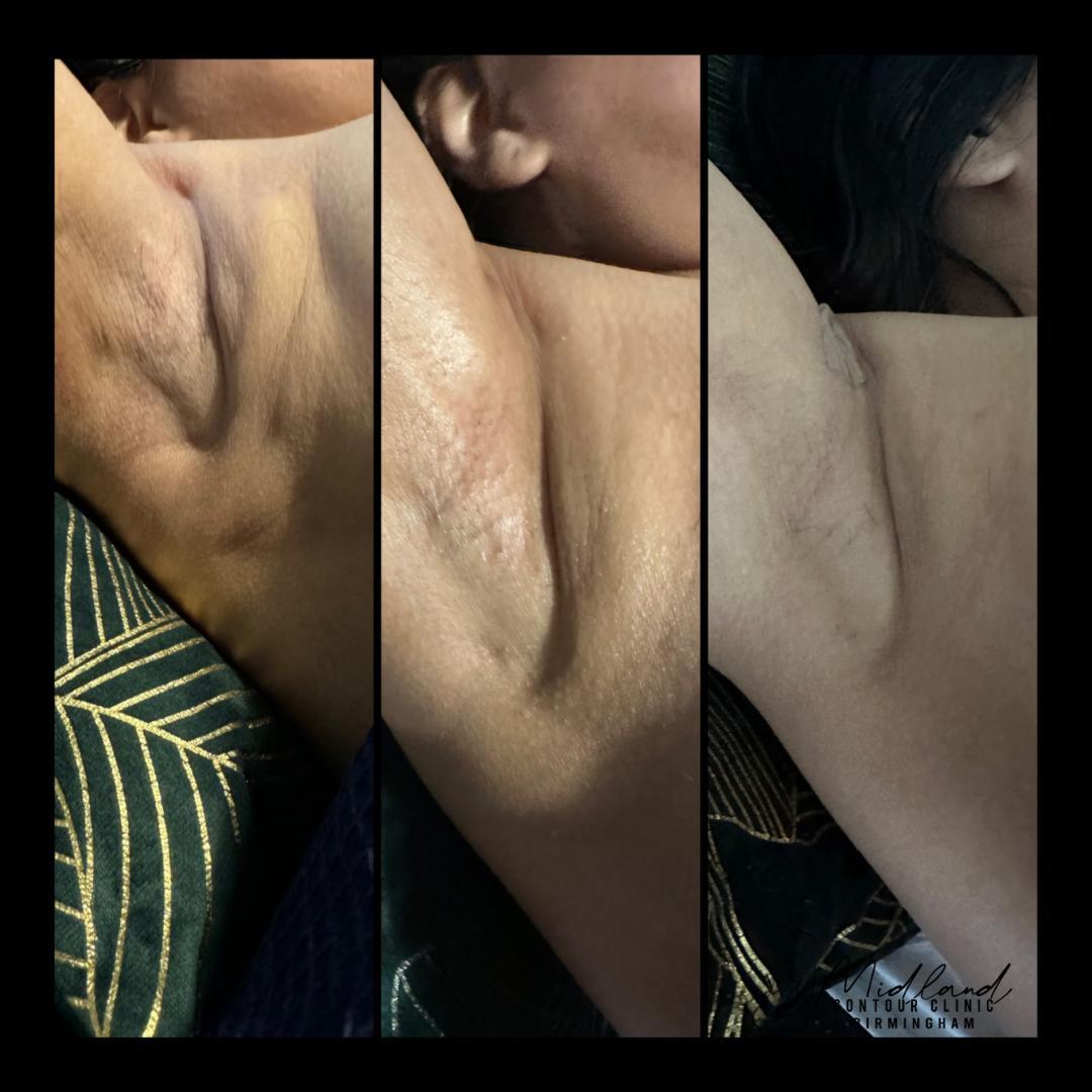 Three photographs of the same client’s upper arm and underarm side by side, the skin becoming progressively smoother and flatter.