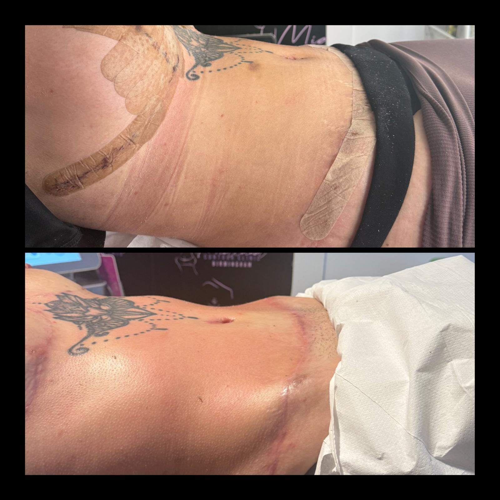 Two photographs of the same client’s abdomen after surgery. In one the scar is covered with silicone scar strips and the surrounding skin is bruised; in the other the scar is uncovered and the bruising has settled.