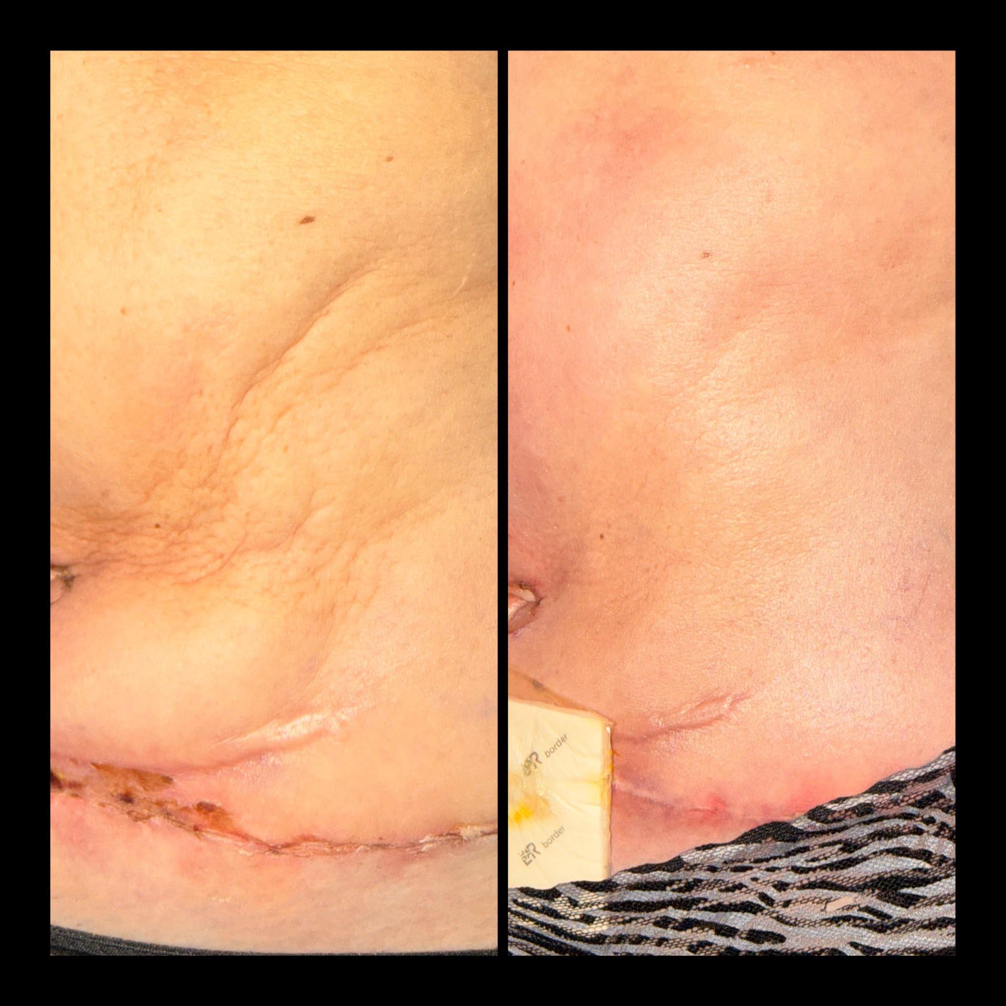 Two photographs of the same client’s abdomen after cosmetic surgery. In one, the skin above the scar is ridged and uneven with hardened tissue beneath it and the scar line is still healing; in the other the same area is smooth and flat, with a dressing over part of the scar.